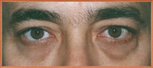 Желто коричневые круги вокруг глаз. Возникли коричневые и желто-серые круги под глазами у мужчин: где искать причины?