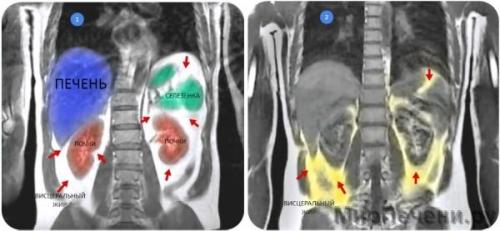 Ожирение внутренних органов название. Влияние ожирения на внутренние органы. Внутреннее ожирение