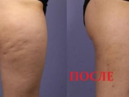 Обертывания от целлюлита в домашних. Для живота 02 Обертывания от целлюлита в домашних. Для живота 02