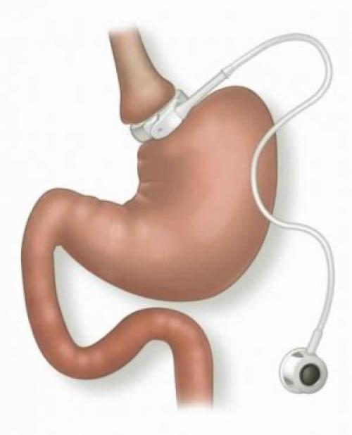 Кольцо для похудения. силиконовое магнитное кольцо для похудения, кто, что знает или пробовал? 01