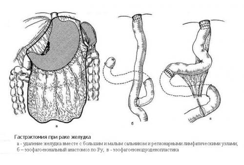 Дистальная субтотальная резекция желудка ход операции. Операция резекции и гастрэктомии
