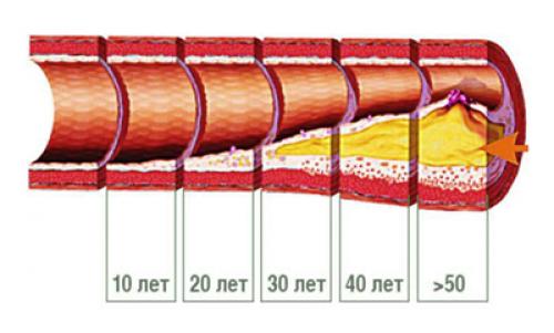 Снизить холестерин срочно. Как понизить уровень холестерина в крови?