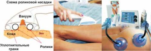 Массаж от целлюлита аппаратный. Польза и вред аппаратного вакуумного антицеллюлитного массажа