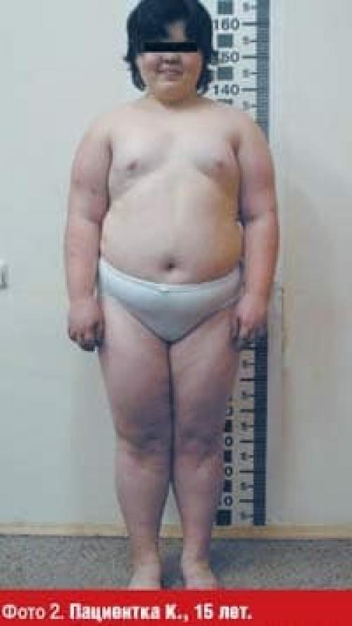 Как определить лишний вес у ребенка. Как определить — таблица стадий по возрасту