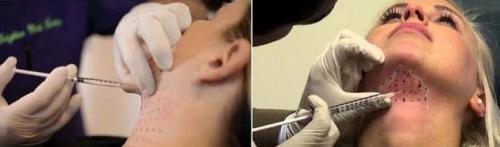 Липолитики для похудения инъекции. Что такое липолитики для похудения 04 Липолитики для похудения инъекции. Что такое липолитики для похудения 04