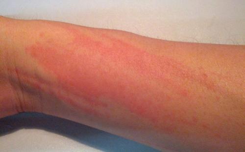 Корица с медом противопоказания. Мед с корицей: вред и польза, правила употребления