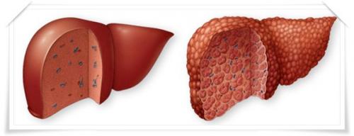 Может ли тыква спасти печень от ожирения. Лечение ожирения печени с помощью питания
