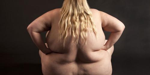 Виды ожирения. Симптомы ожирения: виды и лечение заболевания