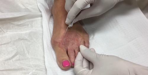 На ногах пальцы облазят. Причины покраснения и шелушения на стопах