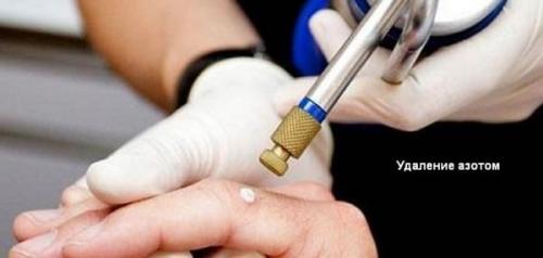 Вирусная бородавка на пальце руки. Что делать с бородавками на пальцах рук