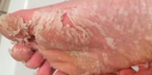 Почему облазит кожа на ступнях у взрослого. Почему облазит кожа на стопах ног