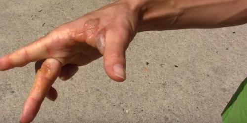 Почему на пальцах лопаются сосуды. В чем кроется проблема