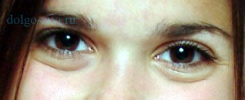 Аптечные средства от мешков под глазами самые эффективные. Существует ли радикальное решение?