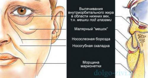 Аптечные средства от мешков под глазами самые эффективные. Существует ли радикальное решение?