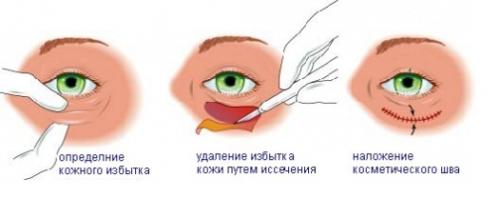 Крем от мешков под глазами. Наиболее распространенные способы устранения отеков под глазами 08 Крем от мешков под глазами. Наиболее распространенные способы устранения отеков под глазами 08
