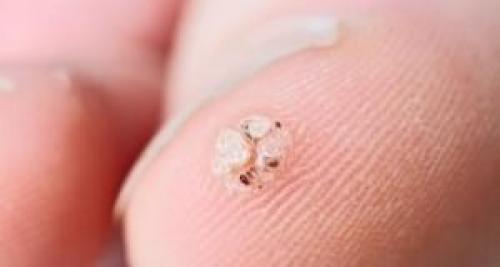 Вирусная бородавка на пальце руки. Что делать с бородавками на пальцах рук