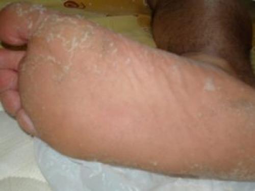 Почему облазит кожа на ступнях у взрослого. Почему облазит кожа на стопах ног