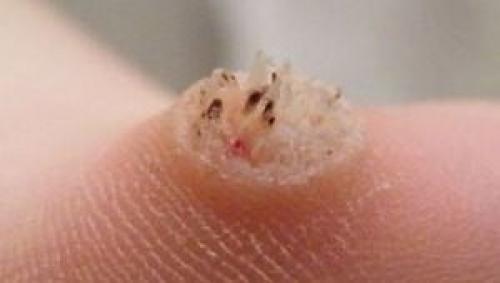 Вирусная бородавка на пальце руки. Что делать с бородавками на пальцах рук