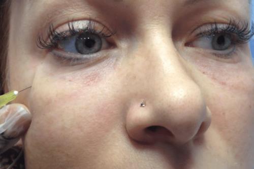 Как убрать мешки под глазами в 55 лет. Как убрать мешки под глазами у женщин