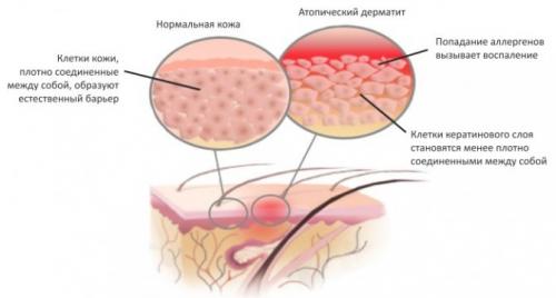 Резкое покраснение кожи и зуд. Народные средства