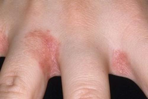 Между пальцами ног облазит кожа и запах. Преет кожа между пальцами ног и запах