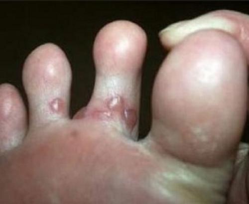 Мозоль между пальцами ног народные средства. Причины появления межпальцевых мозолей