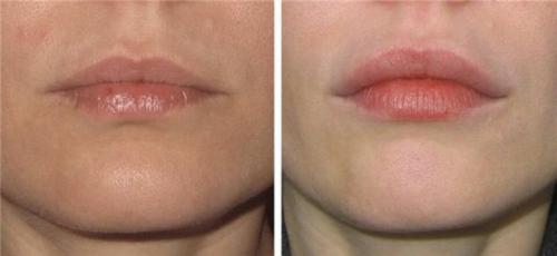 Какой филлер дольше держится в губах. Увеличение губ филлерами