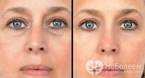 Как убрать отеки под глазами