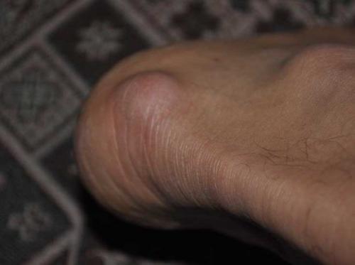 Мозоль на большом пальце ноги. Виды мозолей