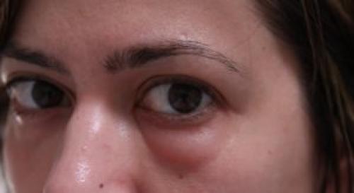 Копеечное средство от мешков под глазами. Мази от мешков под глазами