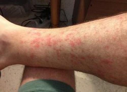 Зуд и покраснение кожи на ногах. Симптомы и сопутствующие им болезни