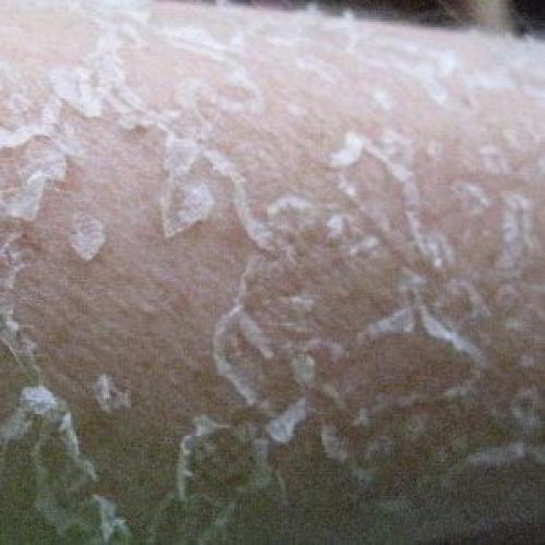 Почему облазит кожа на ступнях у взрослого. Причины шелушения ног