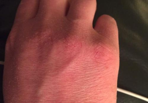 Шелушатся подушечки пальцев причины. Причины