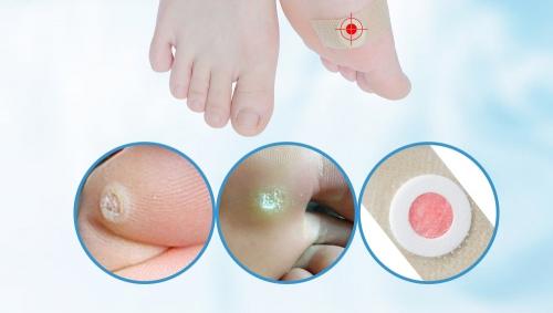 Стержневая мозоль на пальце ноги. Стержневая мозоль