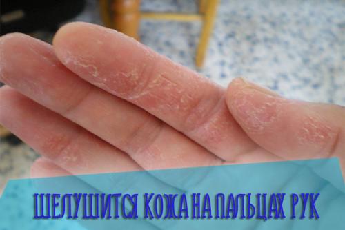На подушечках пальцев рук шелушится кожа. Почему шелушится кожа на пальцах рук?