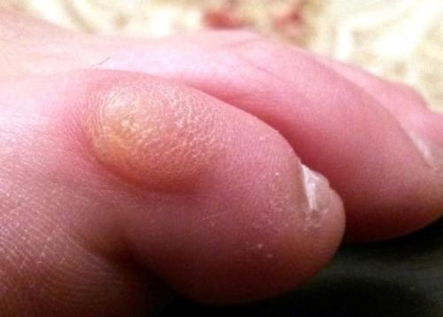 Водянистая мозоль на пальце ноги. Лечение мозоли в домашних условиях – народные средства: как избавиться и что понадобится для лечения