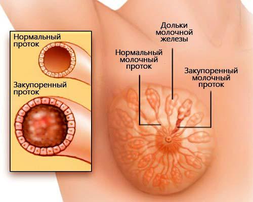 Овальное уплотнение в молочной железе. Основные виды уплотнений