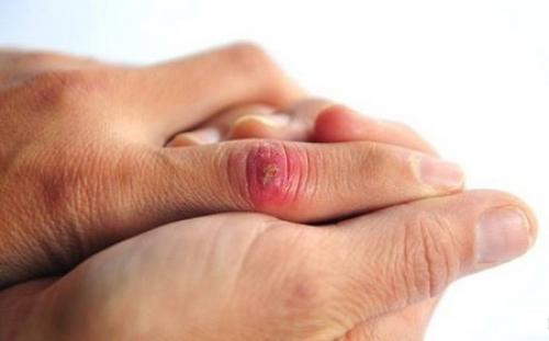 Крем заживляющий трещины. Мази для заживления гнойных ран