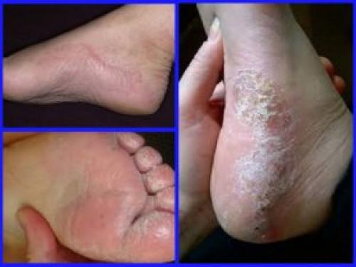 Почему облазит кожа на ступнях у взрослого. Почему на ступнях облазит кожа и лечение