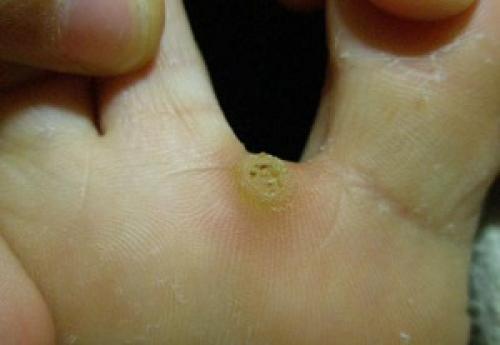 Мозоль между пальцами ног народные средства. Причины появления межпальцевых мозолей