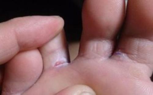 Между пальцами ног облазит кожа и запах. Преет кожа между пальцами ног и запах