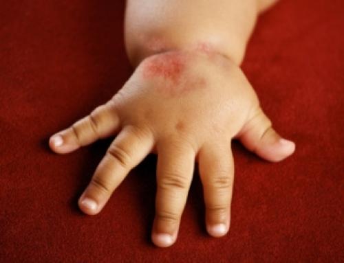 Мазь от аллергии для детей. Общие сведения