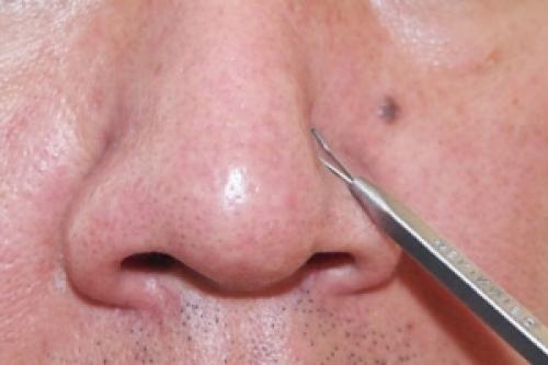 Как избавиться от черных точек на лице в домашних условиях. Секреты очищения кожи