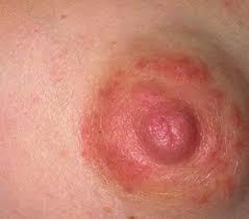 Корочка на ореоле соска. Красные пятна