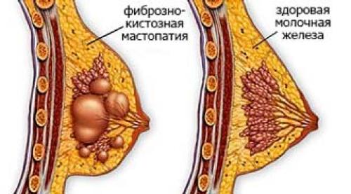 Фиброзно Кистозная Мастопатия Молочной Железы Фото