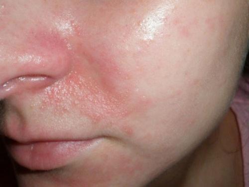 Витамины для кожи лица от прыщей. Витамины от прыщей и угрей на лице: признаки нехватки и обзор препаратов