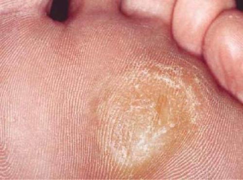 Как удалить мозоль на пальце ноги. Обзор средств и методов для удаления мозолей на пальцах ног в домашних условиях