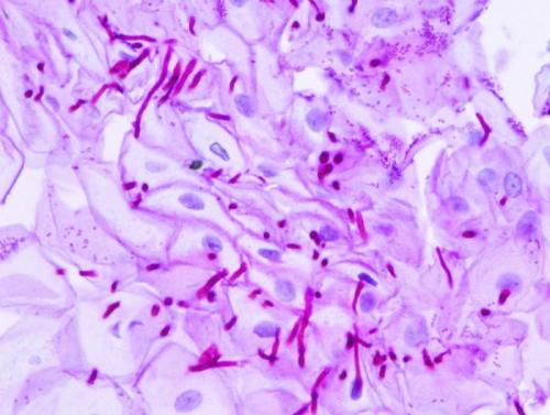 Нити мицелия в мазке, как лечить. Что означает мицелий в мазке у мужчин?