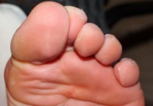 Между пальцами ног образование с точкой. Как и чем лечить болезненное образование между пальцами ног