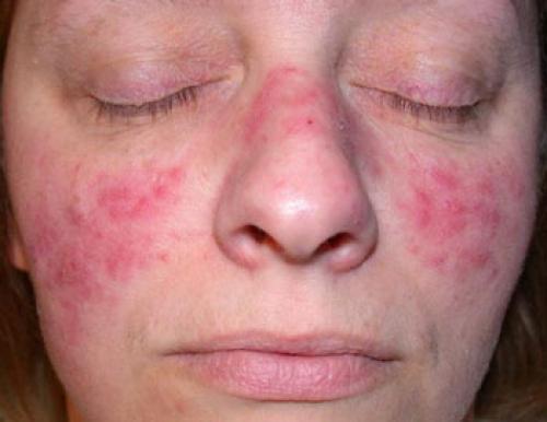 Покраснение на лице возле носа. Покраснение и шелушение вокруг носа: какие факторы провоцируют симптом, и как от него избавиться?